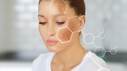 Dark spots, freckles, hyperpigmentation (melasma)