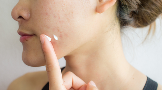 Applying acne cream on her face.