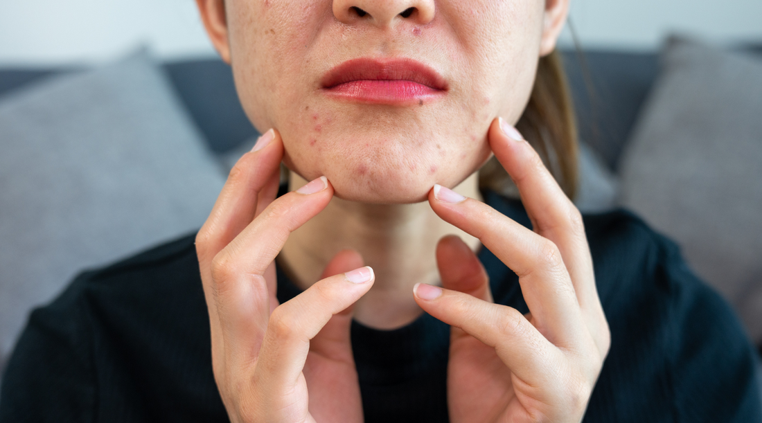 Worried woman with acne problem.