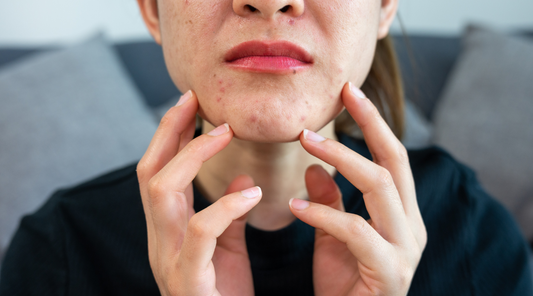 Worried woman with acne problem.