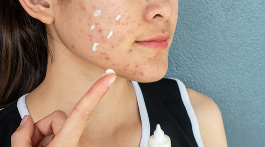 Ivermectin cream on face