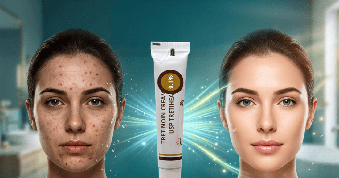 Tretinoin Cream USP 0.1% before and after acne treatment results on woman's face