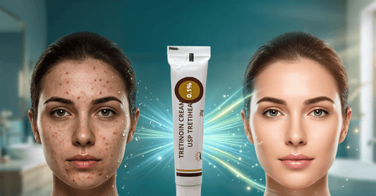 Tretinoin Cream USP 0.1% before and after acne treatment results on woman's face